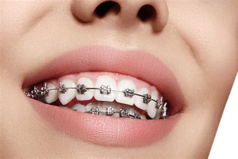 brackets de metal